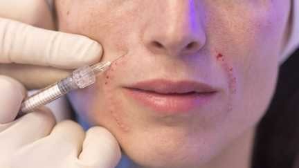 Injections esthétiques illégales: 5 000 médecins réclament des sanctions plus dures